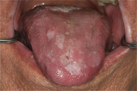 geographic tongue pain #11